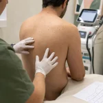 Épilation laser homme dos : consultation Alexandrite ou Nd:YAG